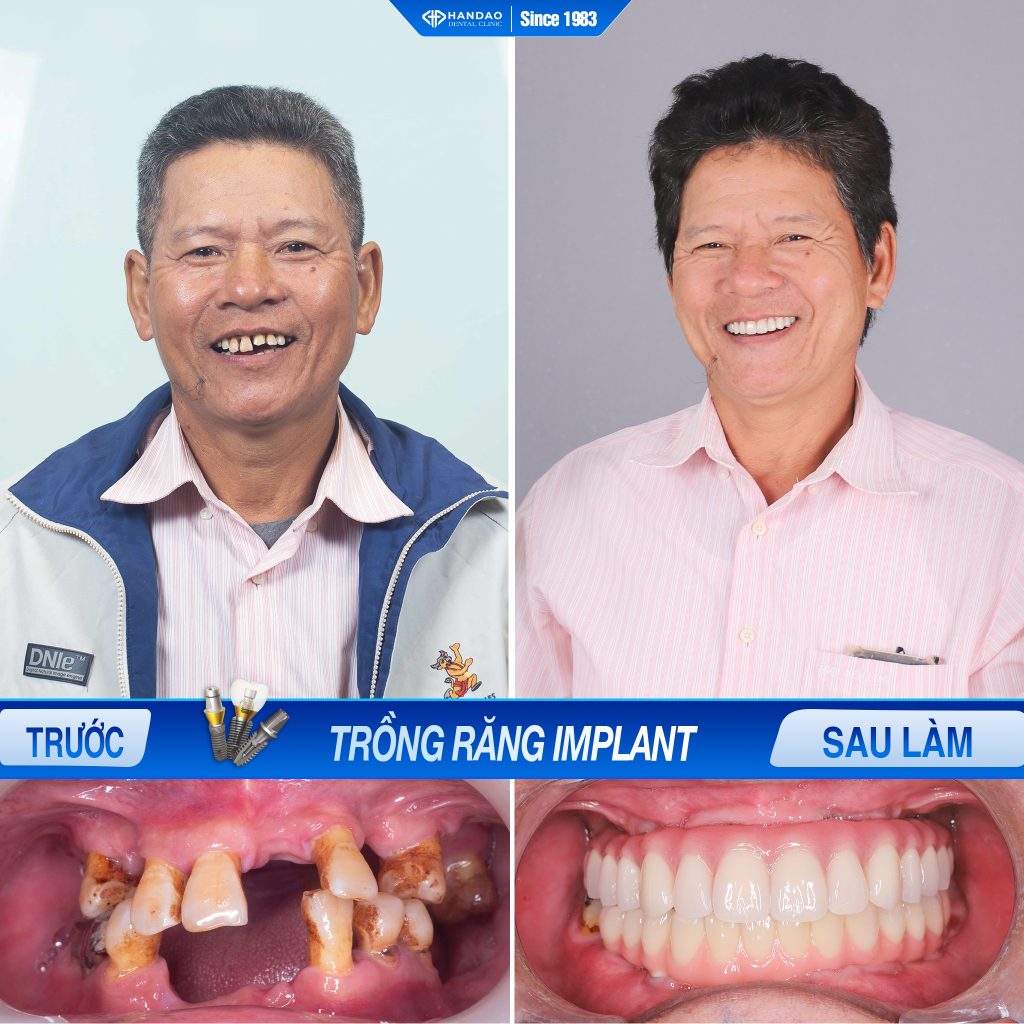 Khách hàng trồng răng implant nguyên hàm - Chú Chiến Giao Thủy Nam Định