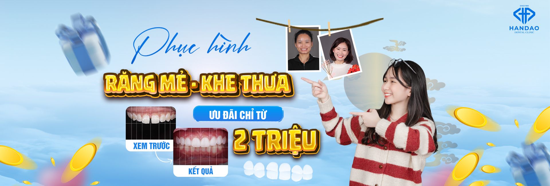 Phục hình răng mẻ, khe thưa - ưu đãi chỉ từ 2 triệu - Nha khoa Hân Đào