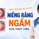 Niềng răng ngầm - hành trình chỉnh nha của Thủy Tiên tại Nha khoa Hân Đào