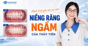 Niềng răng ngầm - hành trình chỉnh nha của Thủy Tiên tại Nha khoa Hân Đào