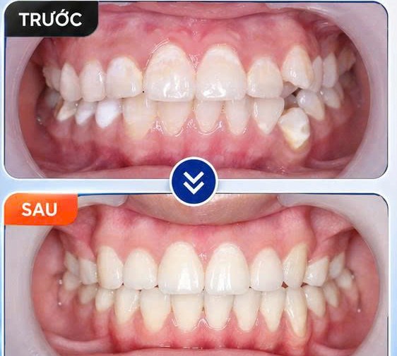 Niềng răng ngầm - trước và sau khi chỉnh nha của bạn Thủy Tiên tại Nha khoa Hân Đào