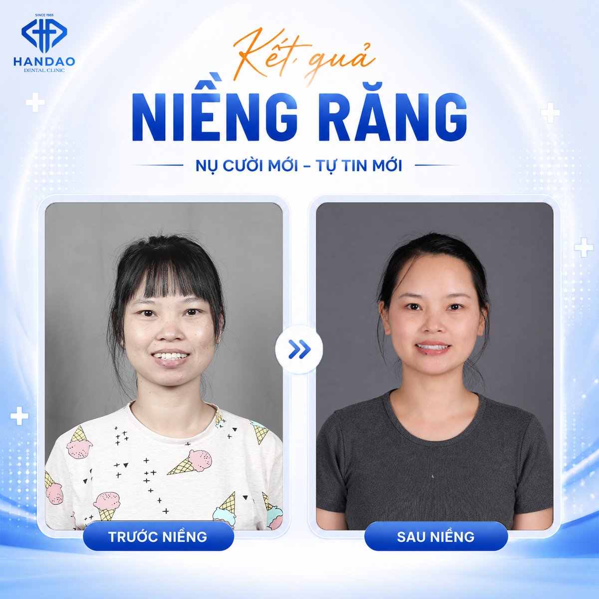 Feedback niềng răng của chị Nguyễn Thị Tươi tại Nha khoa Hân Đào