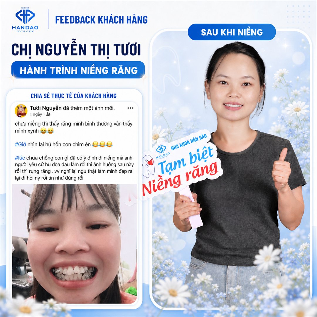 Kết quả niềng răng chị Tươi - gương mặt trước và sau niềng tại Nha khoa Hân Đào