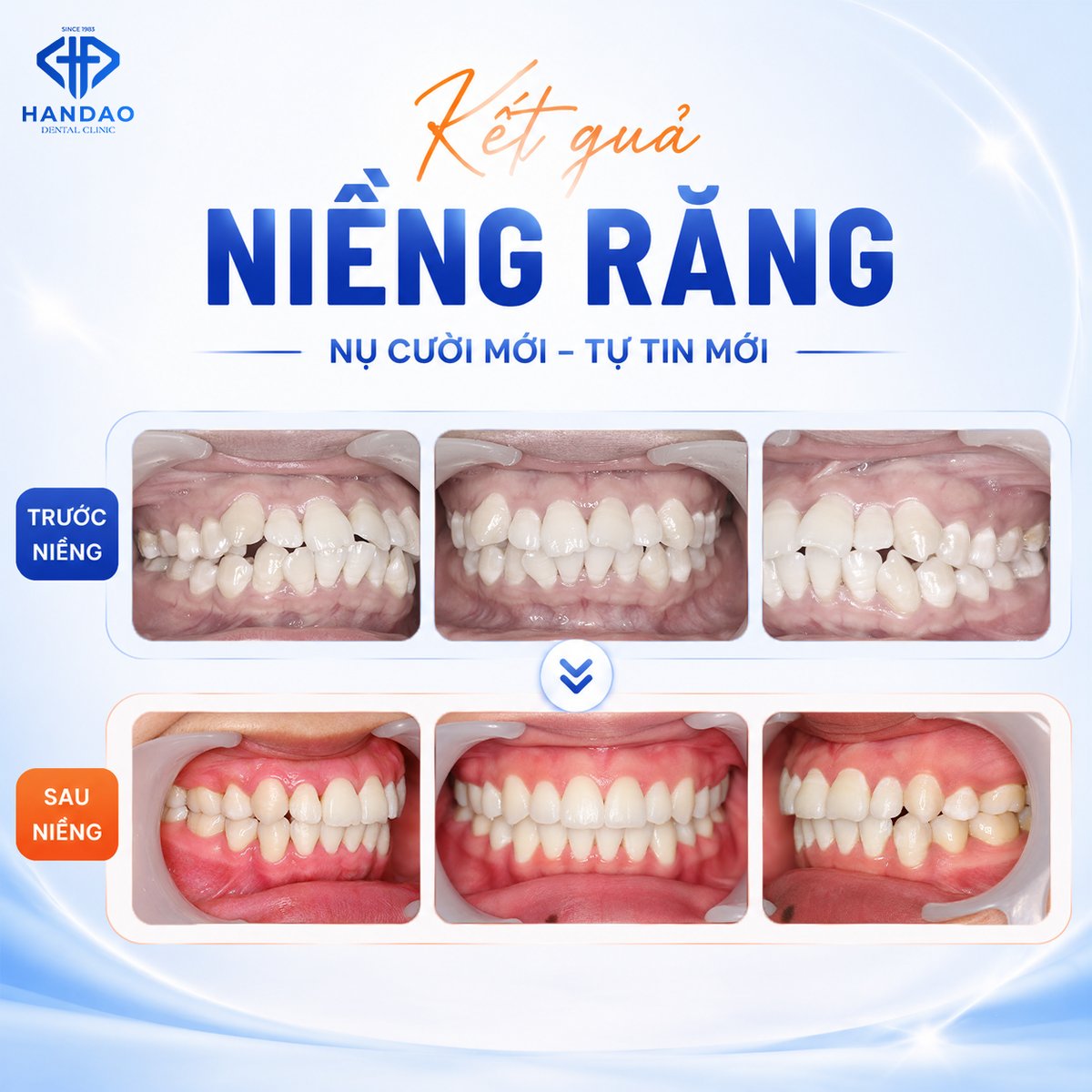 Kết quả niềng răng chị Tươi - hàm trên và hàm dưới trước và sau