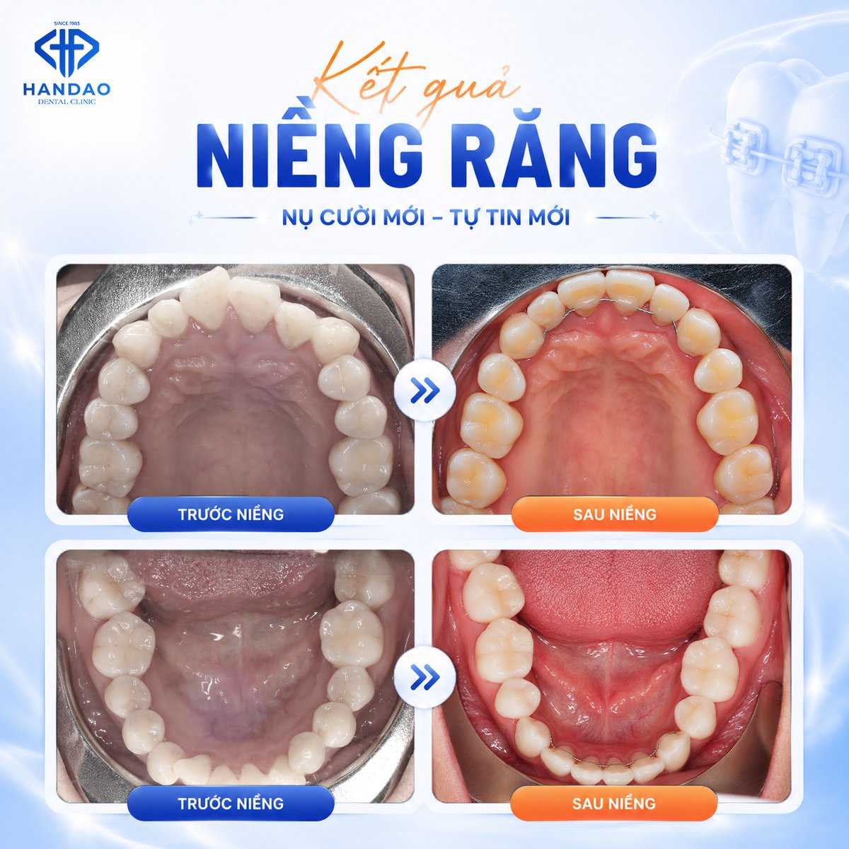 Kết quả niềng răng chị Tươi - ảnh mặt nghiêng hàm răng trước và sau
