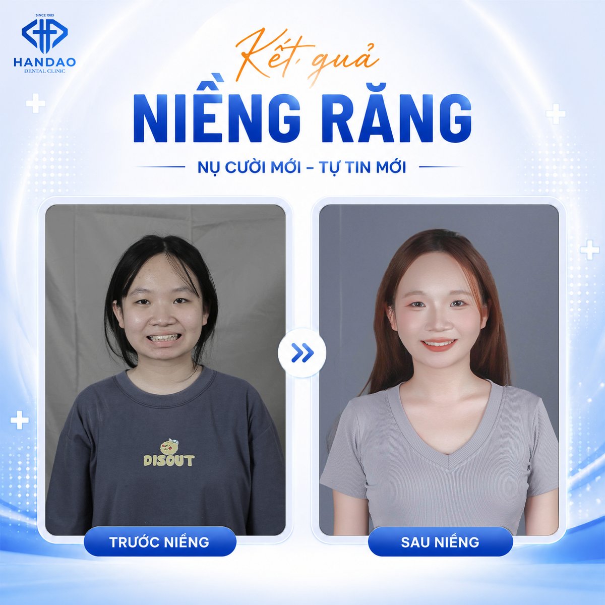 Kết quả niềng răng mắc cài bạn Thảo Ngân - gương mặt trước và sau tại Nha khoa Hân Đào