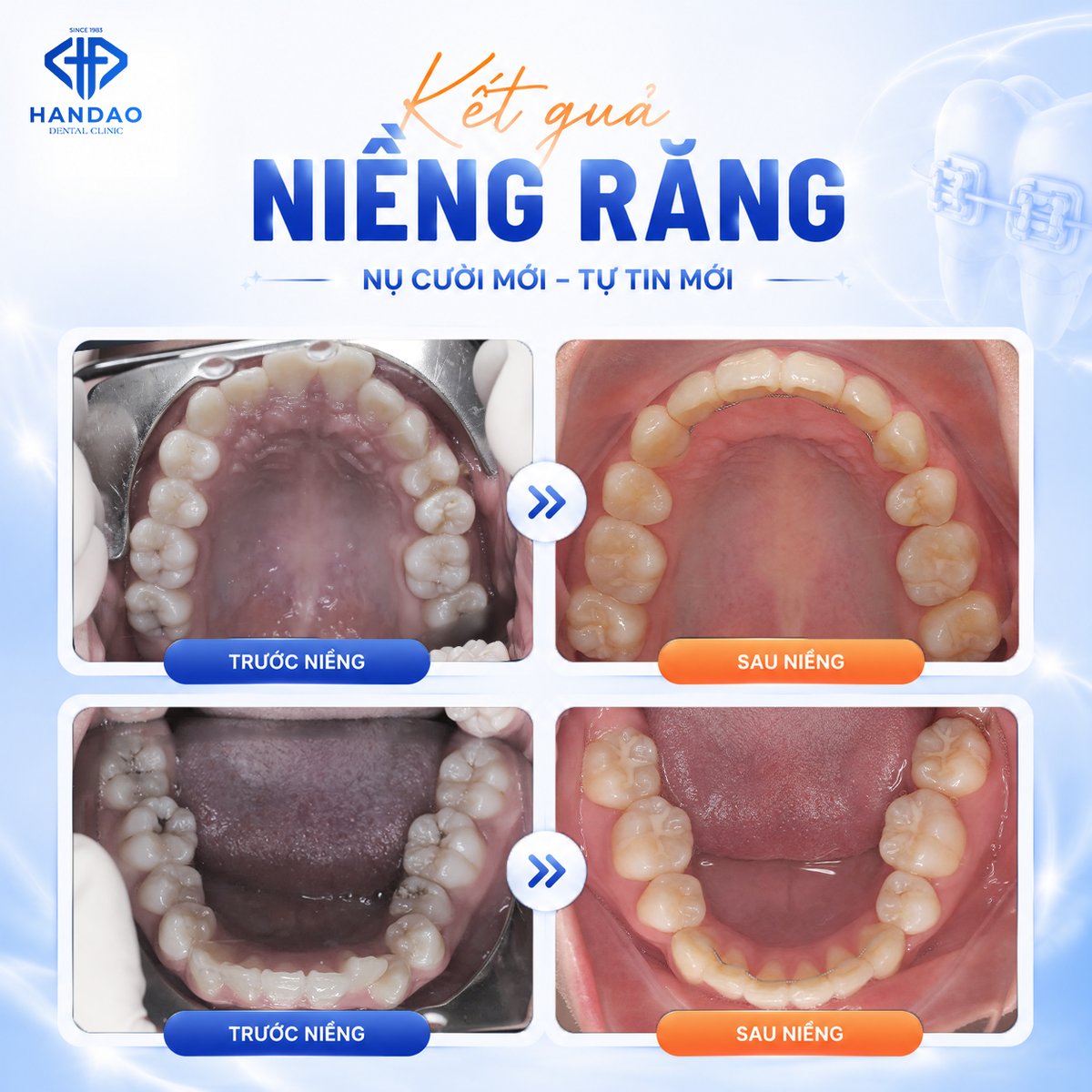 Kết quả niềng răng mắc cài bạn Thảo Ngân - hàm trên và hàm dưới trước sau