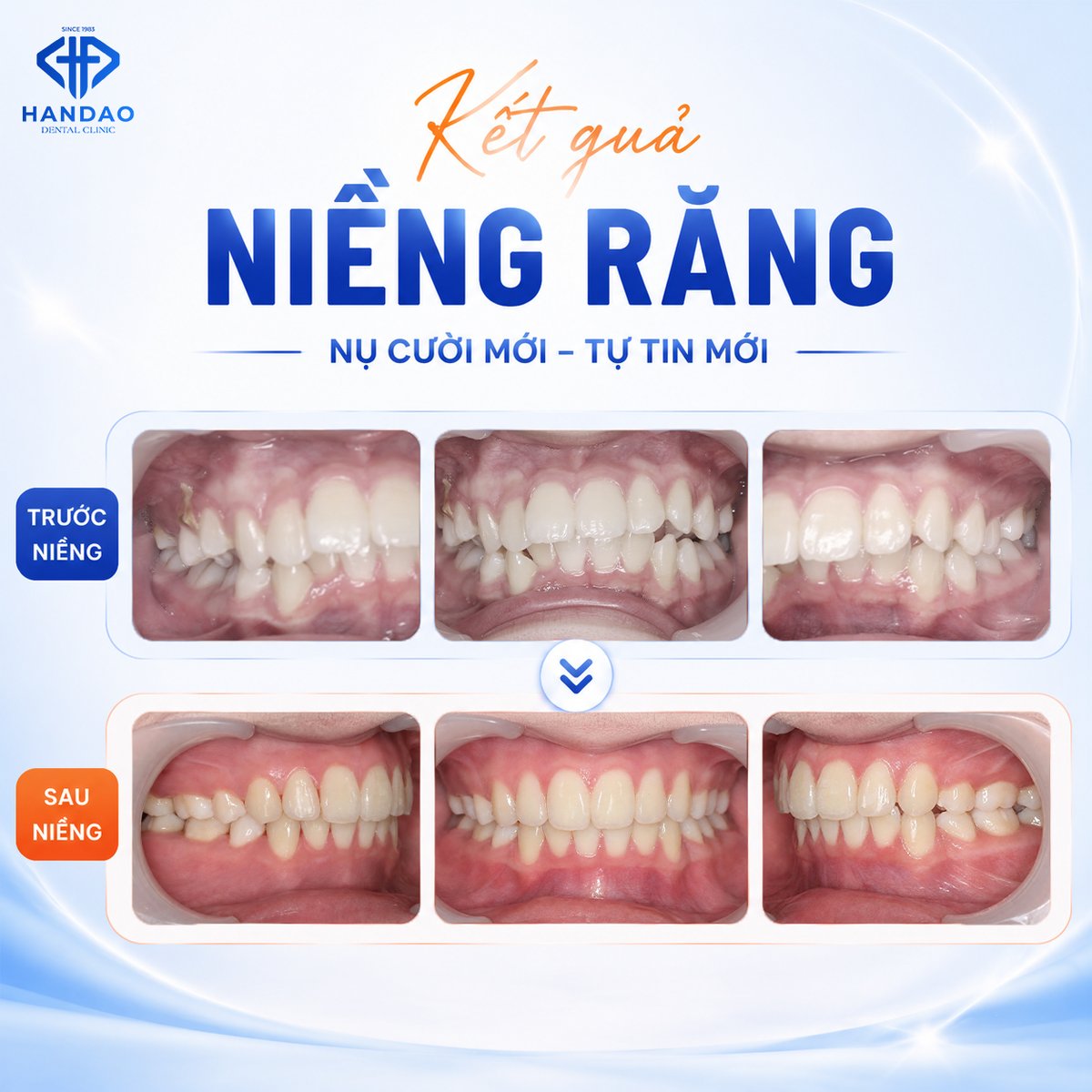 Kết quả niềng răng mắc cài bạn Thảo Ngân - các góc răng trước và sau