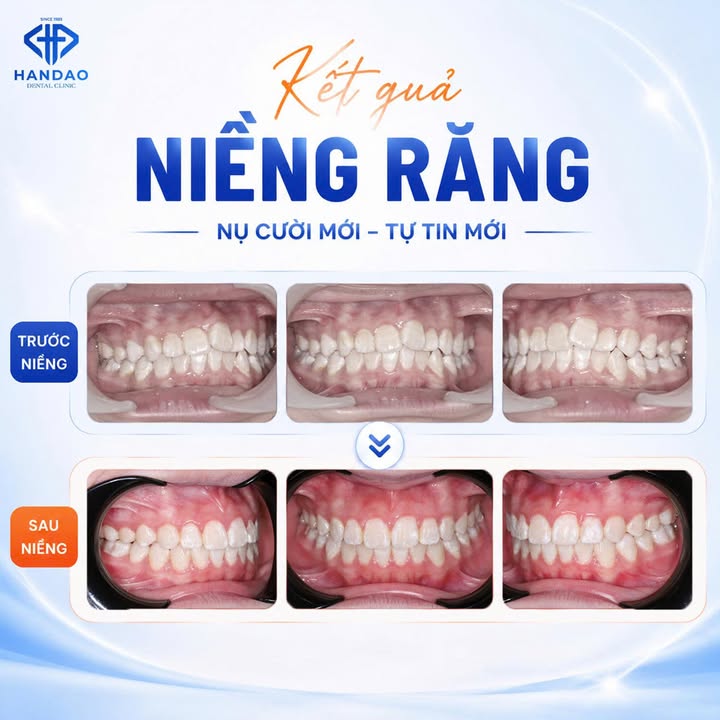 Kết quả niềng răng trước và sau tại Nha khoa Hân Đào Nam Định