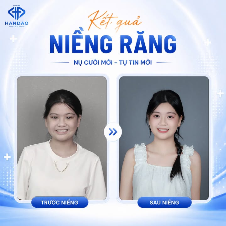 Kết quả niềng răng trước và sau tại Nha khoa Hân Đào Thái Bình