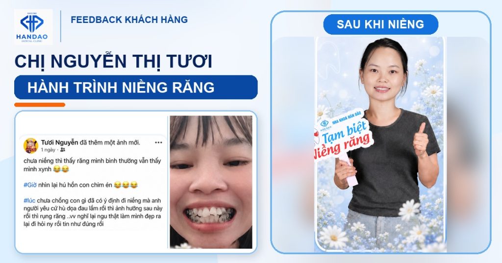Niềng răng - hành trình chị Nguyễn Thị Tươi tại Nha khoa Hân Đào