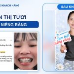 Niềng răng - hành trình chị Nguyễn Thị Tươi tại Nha khoa Hân Đào