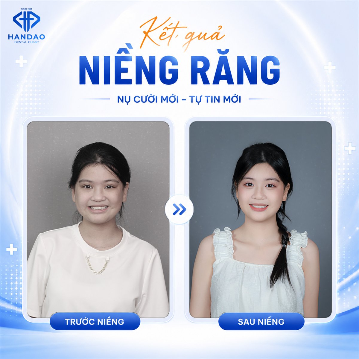 Niềng răng tuổi dậy thì - chân dung trước và sau của Xuân Nhi tại Nha khoa Hân Đào