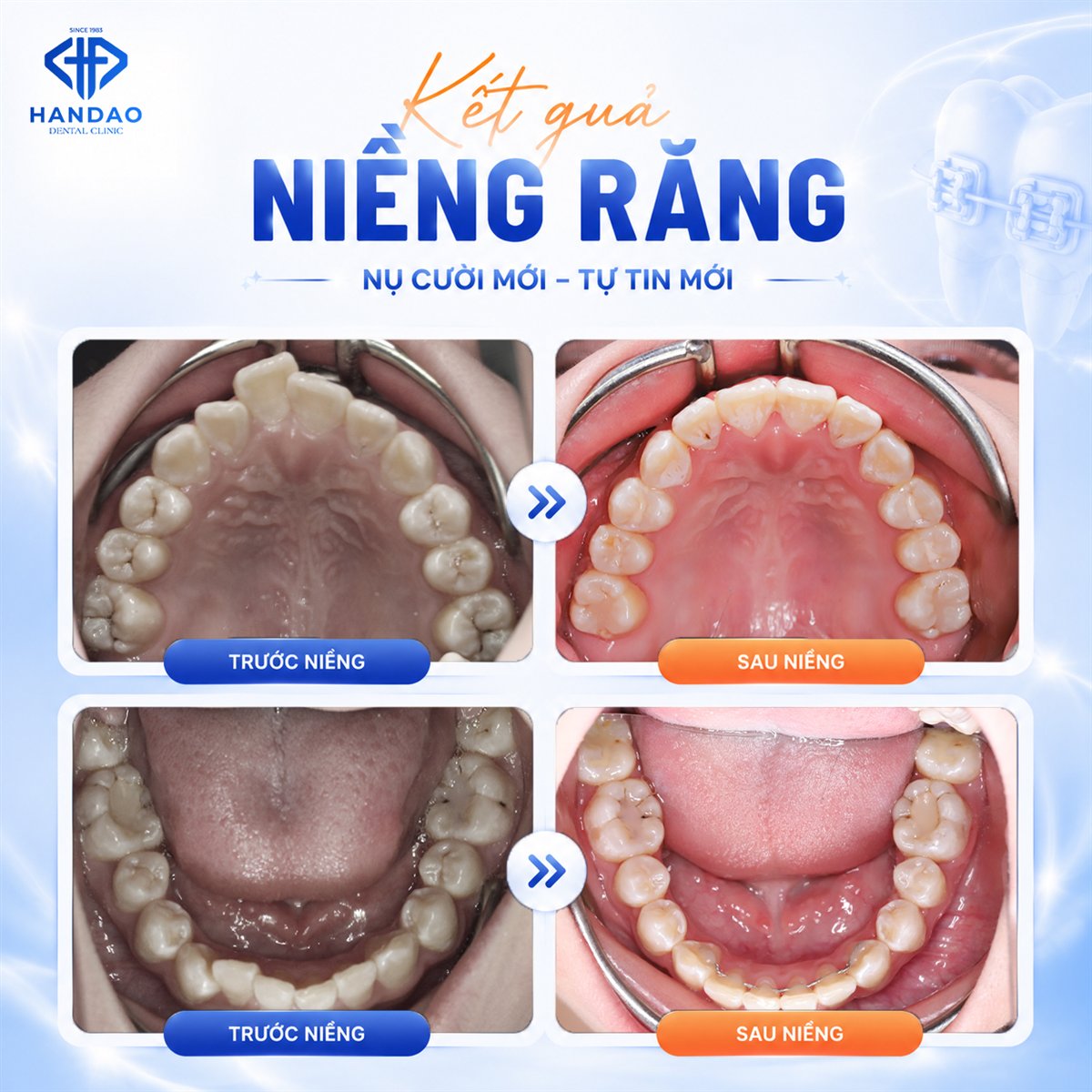Kết quả niềng răng tuổi dậy thì - hàm trên và hàm dưới trước sau tại Nha khoa Hân Đào