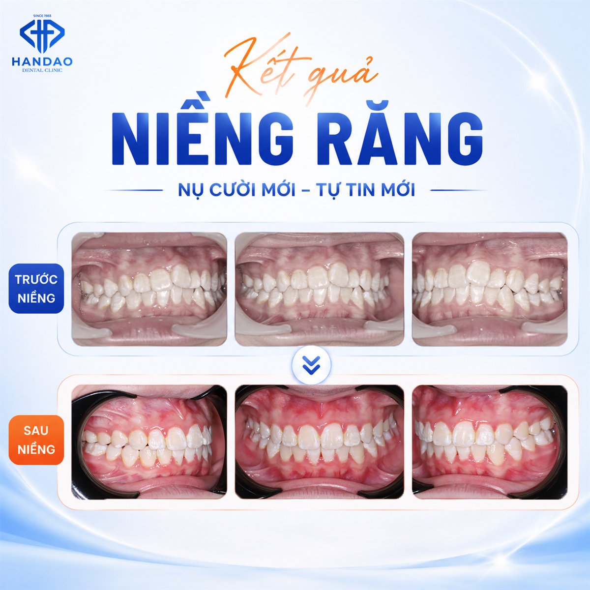 Kết quả niềng răng tuổi dậy thì - răng chen chúc trước và sau khi niềng của Xuân Nhi