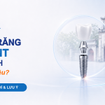 Trồng răng Implant Nam Định giá bao nhiêu - Nha khoa Hân Đào