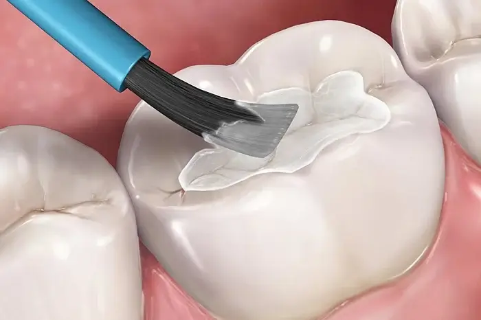 Vật liệu hàn răng Composite và Fuji tại Nha khoa Hân Đào