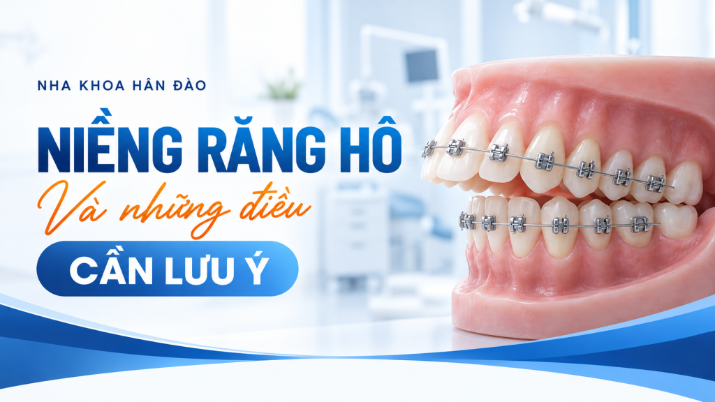 Niềng răng hô và những điều cần lưu ý - Nha khoa Hân Đào