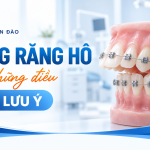 Niềng răng hô và những điều cần lưu ý - Nha khoa Hân Đào