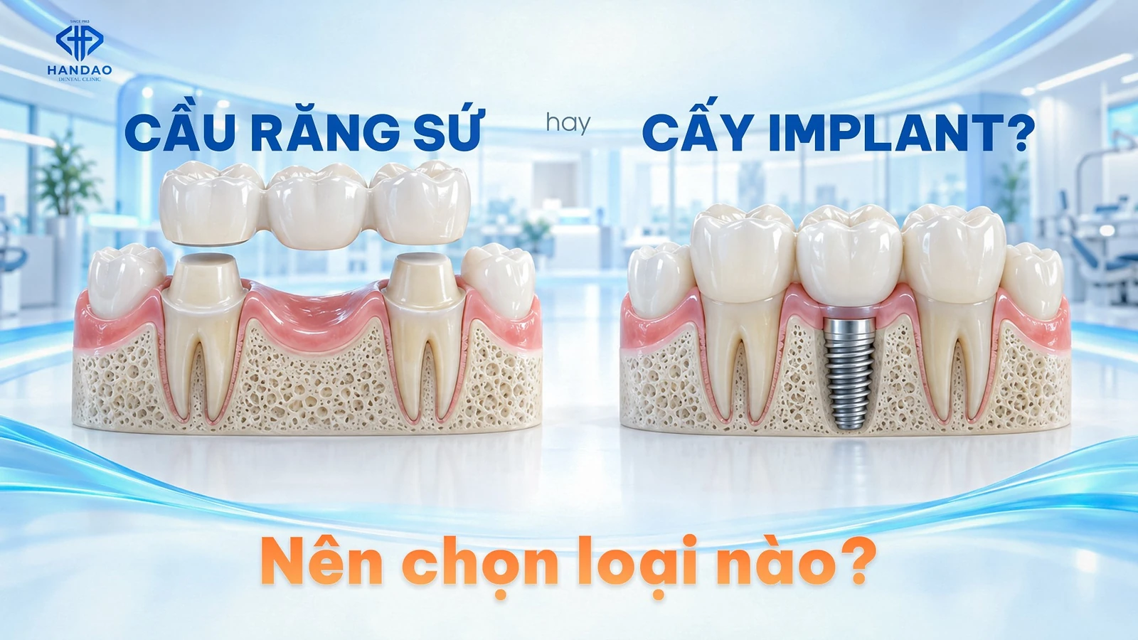 Cầu răng sứ hay cấy Implant? Nên chọn loại nào (2026)