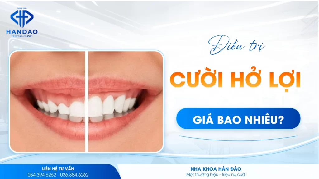 Điều trị cười hở lợi giá bao nhiêu tại Nha khoa Hân Đào