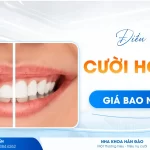 Điều trị cười hở lợi giá bao nhiêu tại Nha khoa Hân Đào