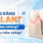 Trồng răng Implant có đau không tại Nha khoa Hân Đào